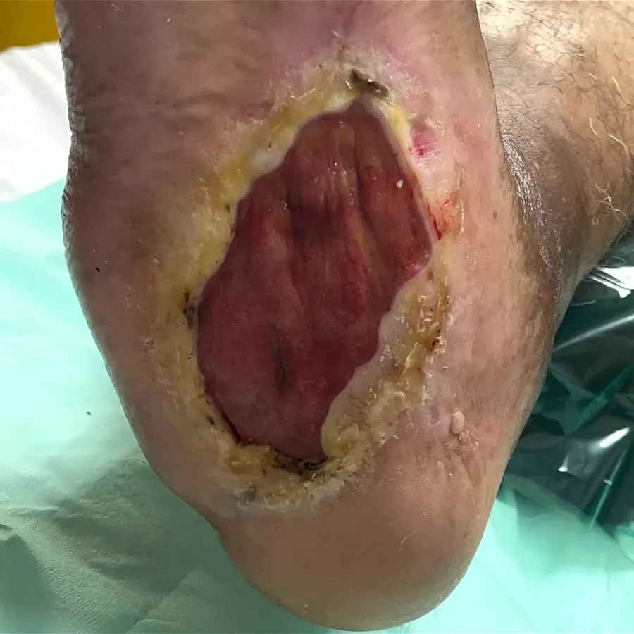 Clinical photograph of a diabetic plantar wound at visit 5, HKL-41