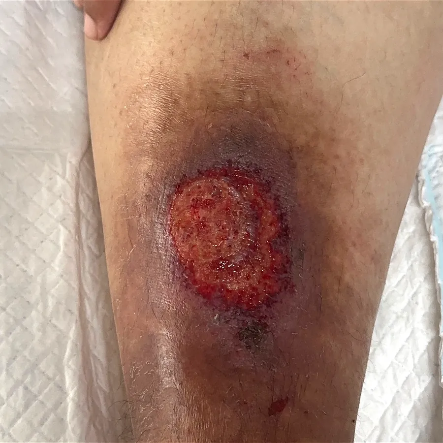 Clinical photograph of a diabetic leg wound at visit 1, HKL-42