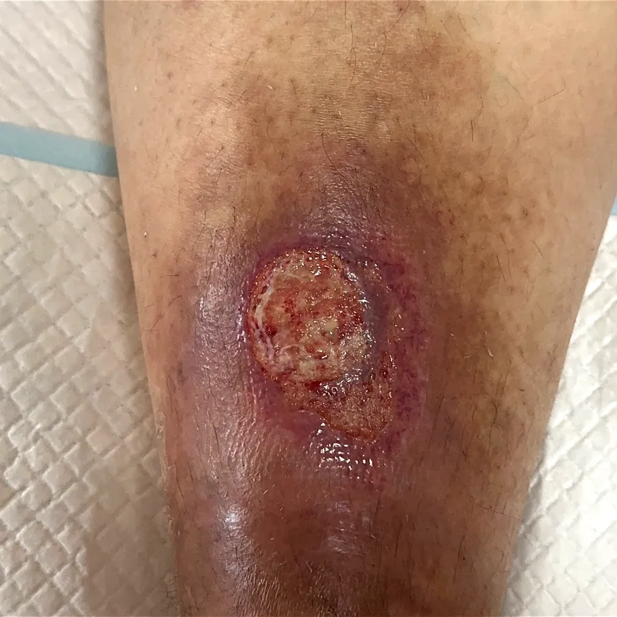 Clinical photograph of a diabetic leg wound at visit 2, HKL-42