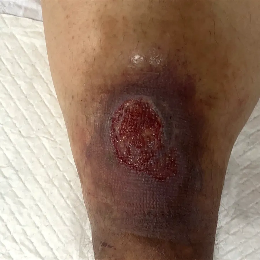 Clinical photograph of a diabetic leg wound at visit 3, HKL-42
