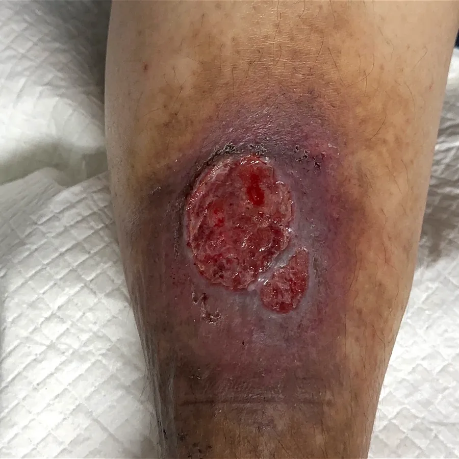 Clinical photograph of a diabetic leg wound at visit 4, HKL-42