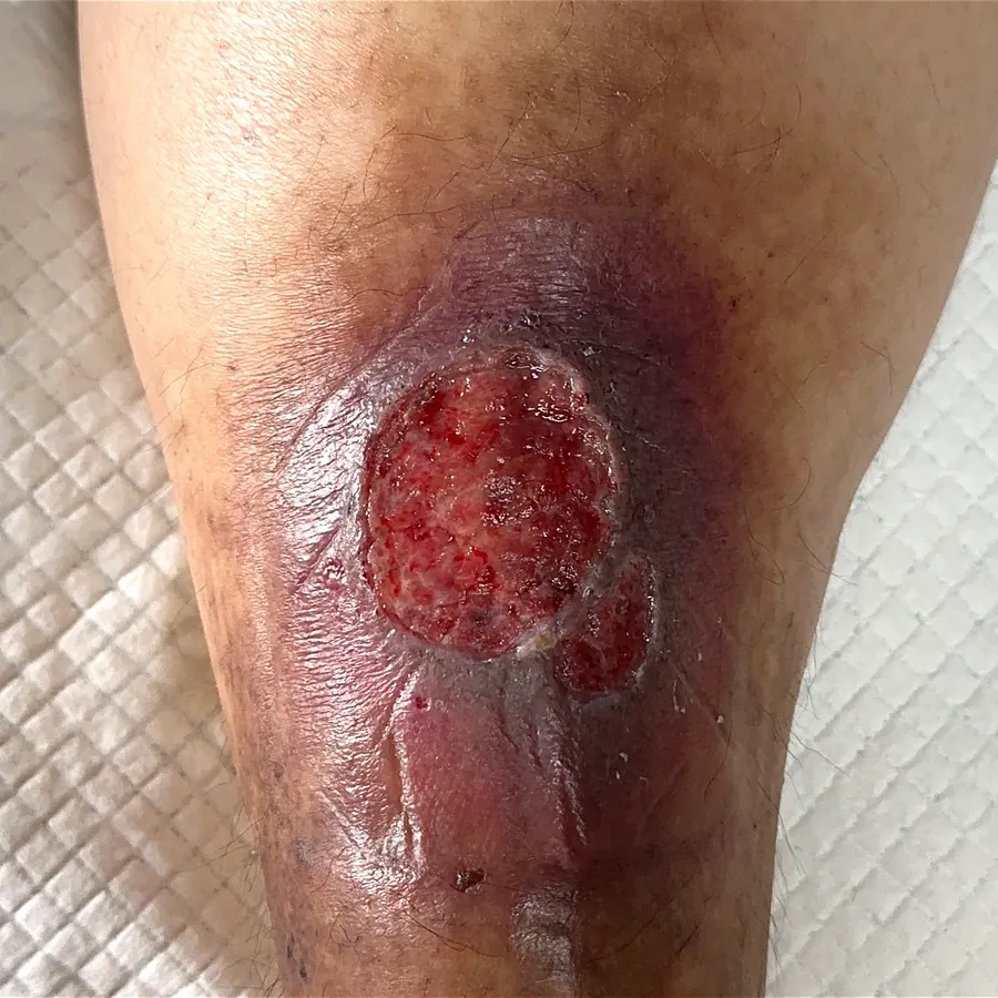 Clinical photograph of a diabetic leg wound at visit 5, HKL-42