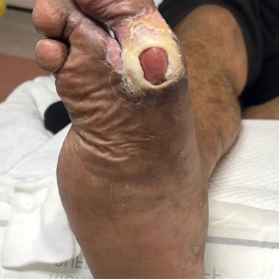 Clinical photograph of a diabetic plantar wound at visit 1, HKL-43