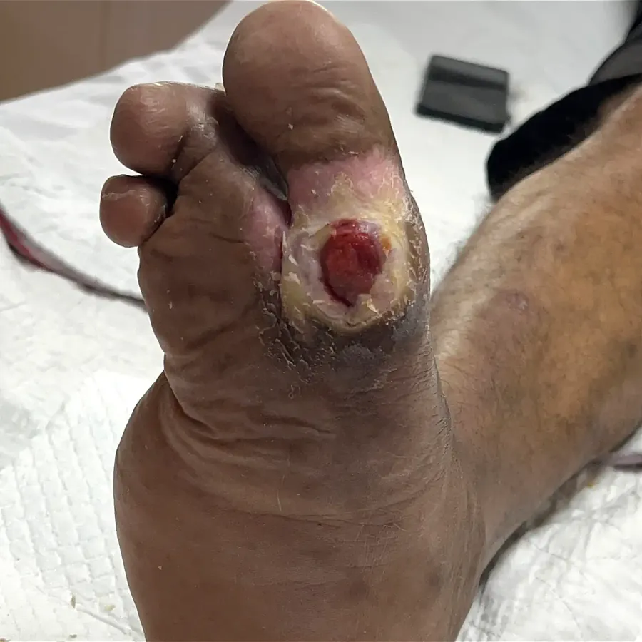 Clinical photograph of a diabetic plantar wound at visit 2, HKL-43