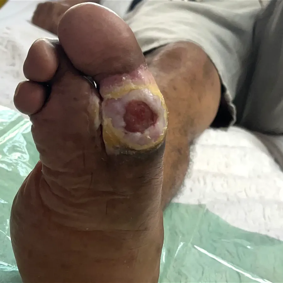 Clinical photograph of a diabetic plantar wound at visit 4, HKL-43