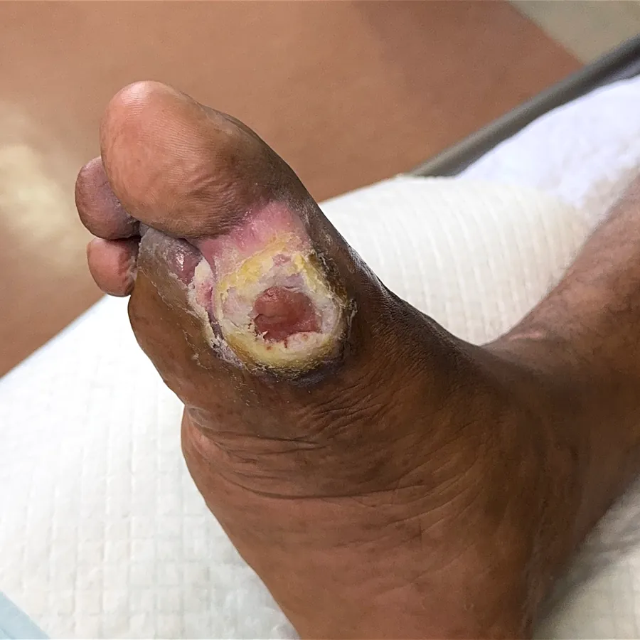 Clinical photograph of a diabetic plantar wound at visit 5, HKL-43