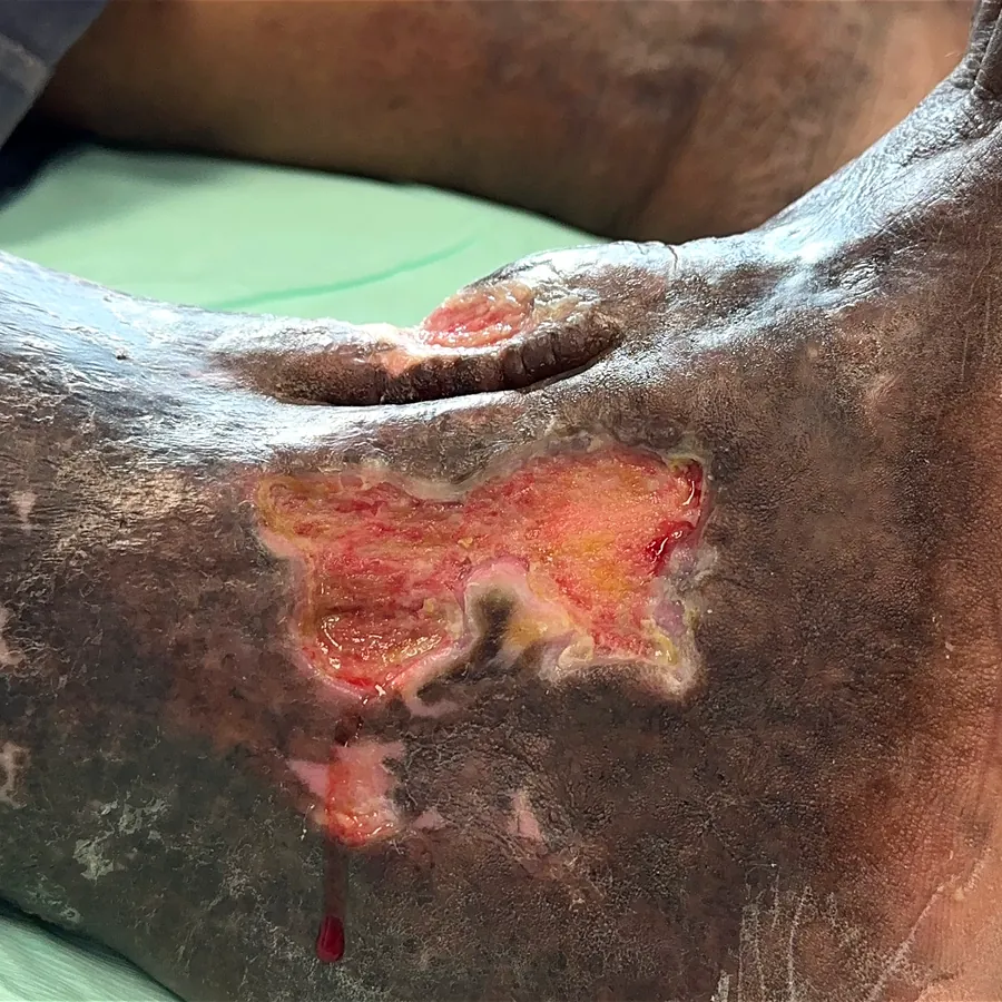 Clinical photograph of a diabetic foot wound at visit 1, HKL-44