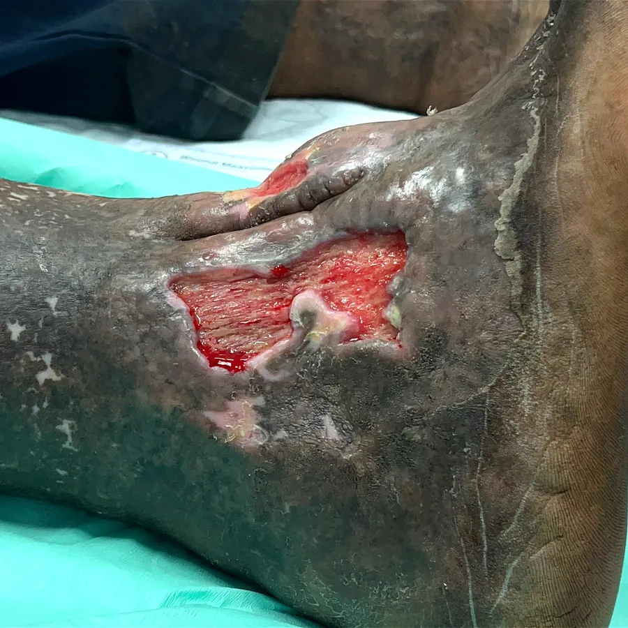 Clinical photograph of a diabetic foot wound at visit 2, HKL-44