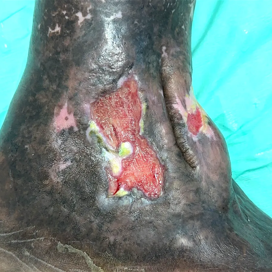 Clinical photograph of a diabetic foot wound at visit 3, HKL-44