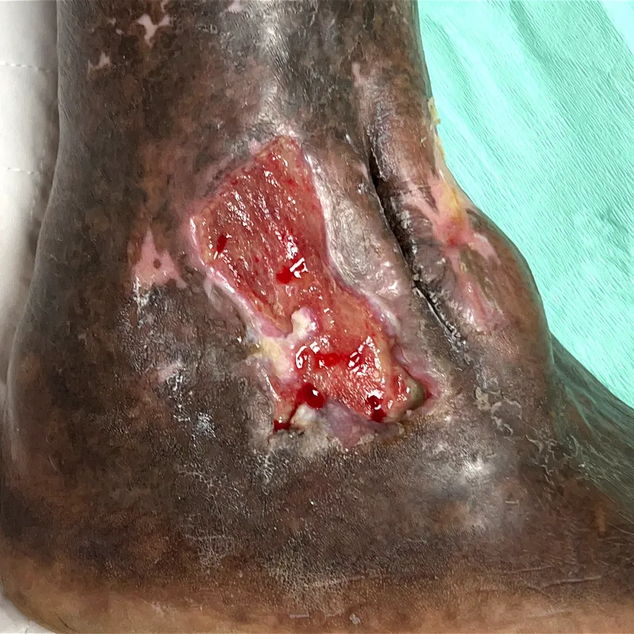 Clinical photograph of a diabetic foot wound at visit 4, HKL-44