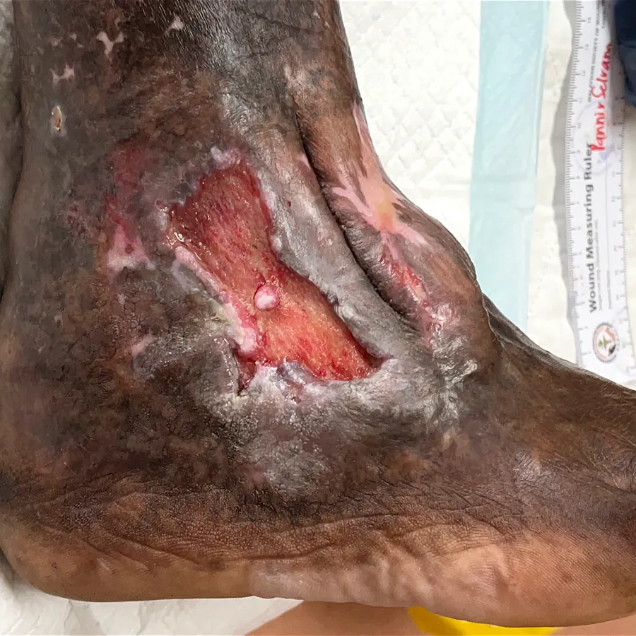 Clinical photograph of a diabetic foot wound at visit 5, HKL-44