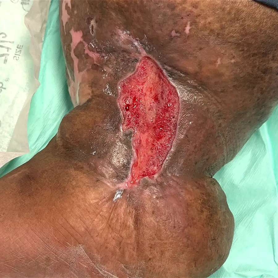 Clinical photograph of a diabetic leg wound at visit 1, HKL-45