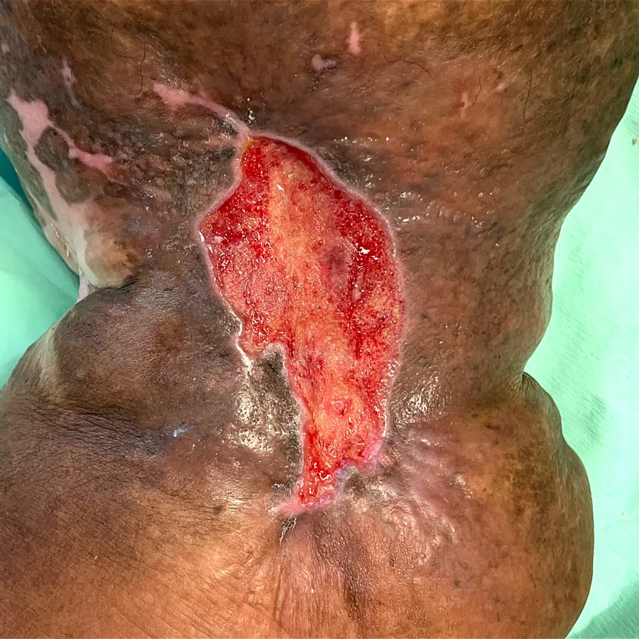 Clinical photograph of a diabetic leg wound at visit 2, HKL-45