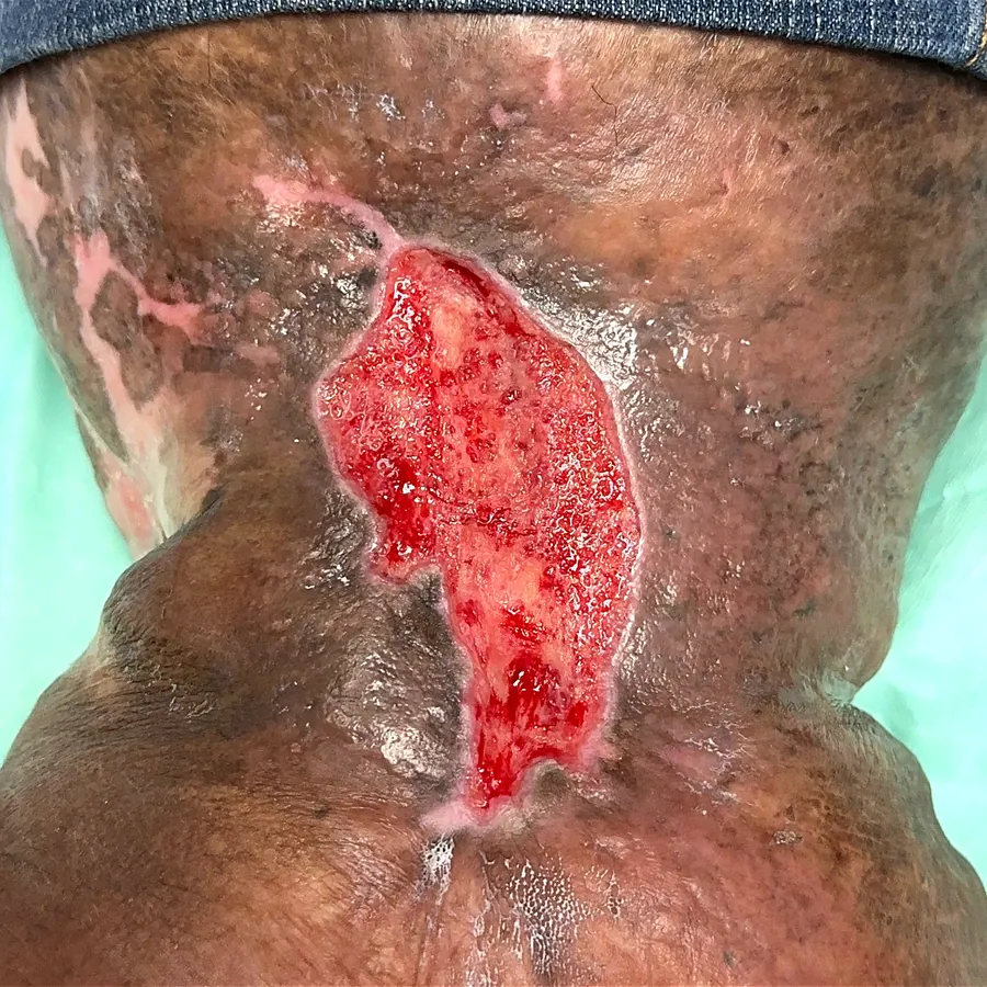 Clinical photograph of a diabetic leg wound at visit 3, HKL-45