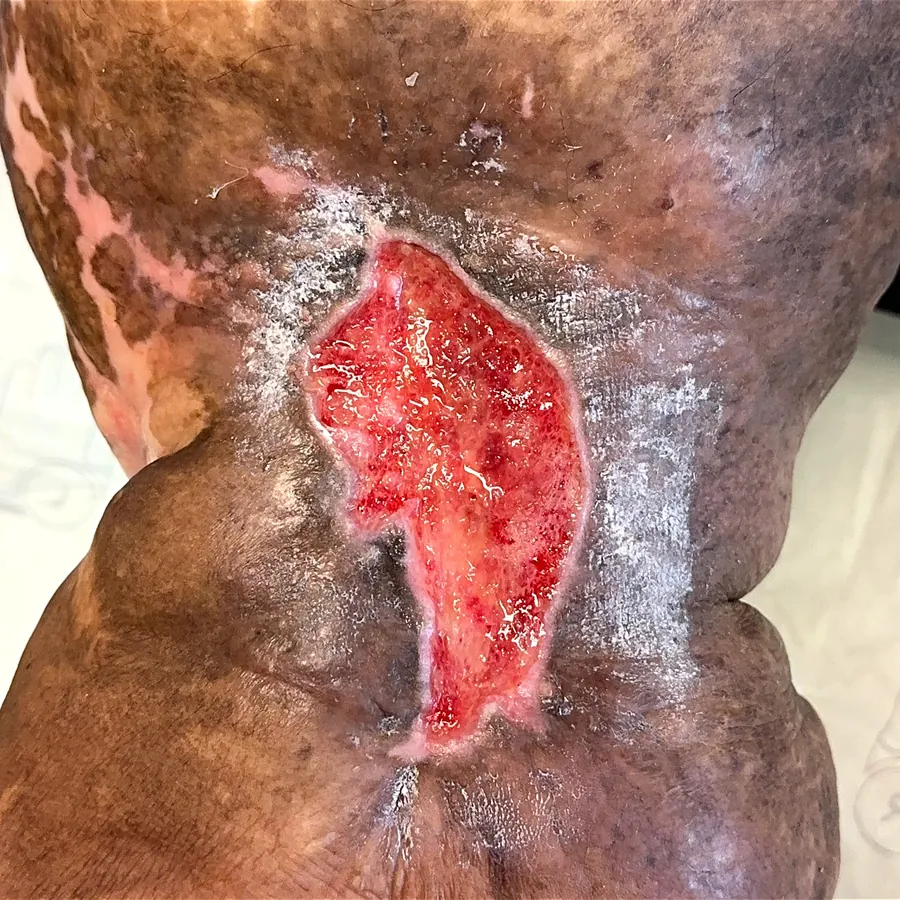 Clinical photograph of a diabetic leg wound at visit 4, HKL-45