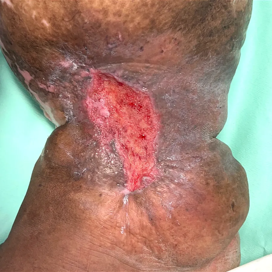 Clinical photograph of a diabetic leg wound at visit 5, HKL-45