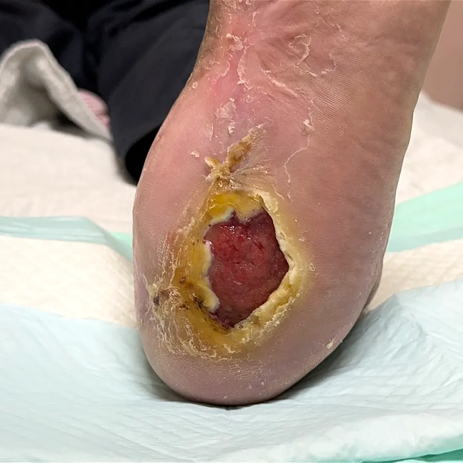 Clinical photograph of a diabetic heel wound at visit 1, HKL-46