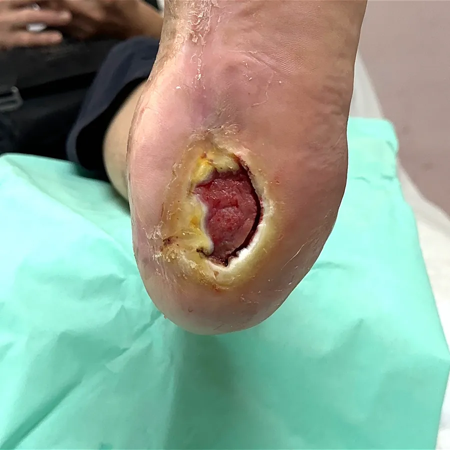 Clinical photograph of a diabetic heel wound at visit 2, HKL-46