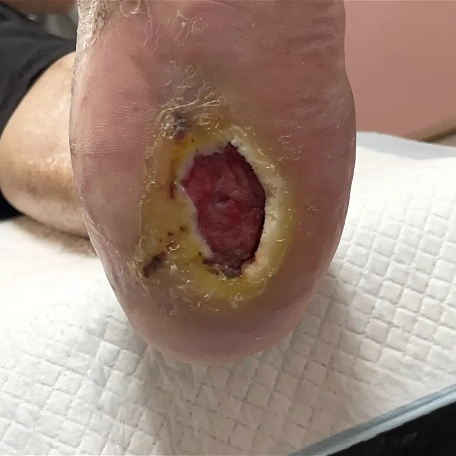 Clinical photograph of a diabetic heel wound at visit 3, HKL-46