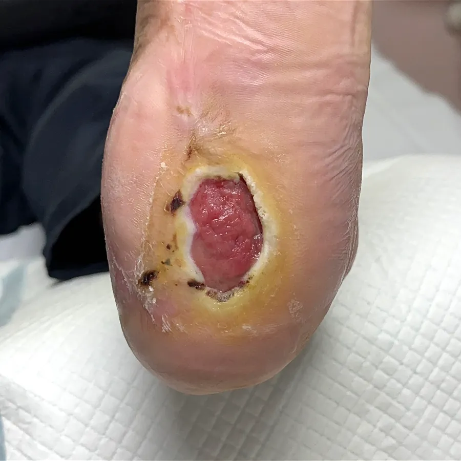 Clinical photograph of a diabetic heel wound at visit 4, HKL-46
