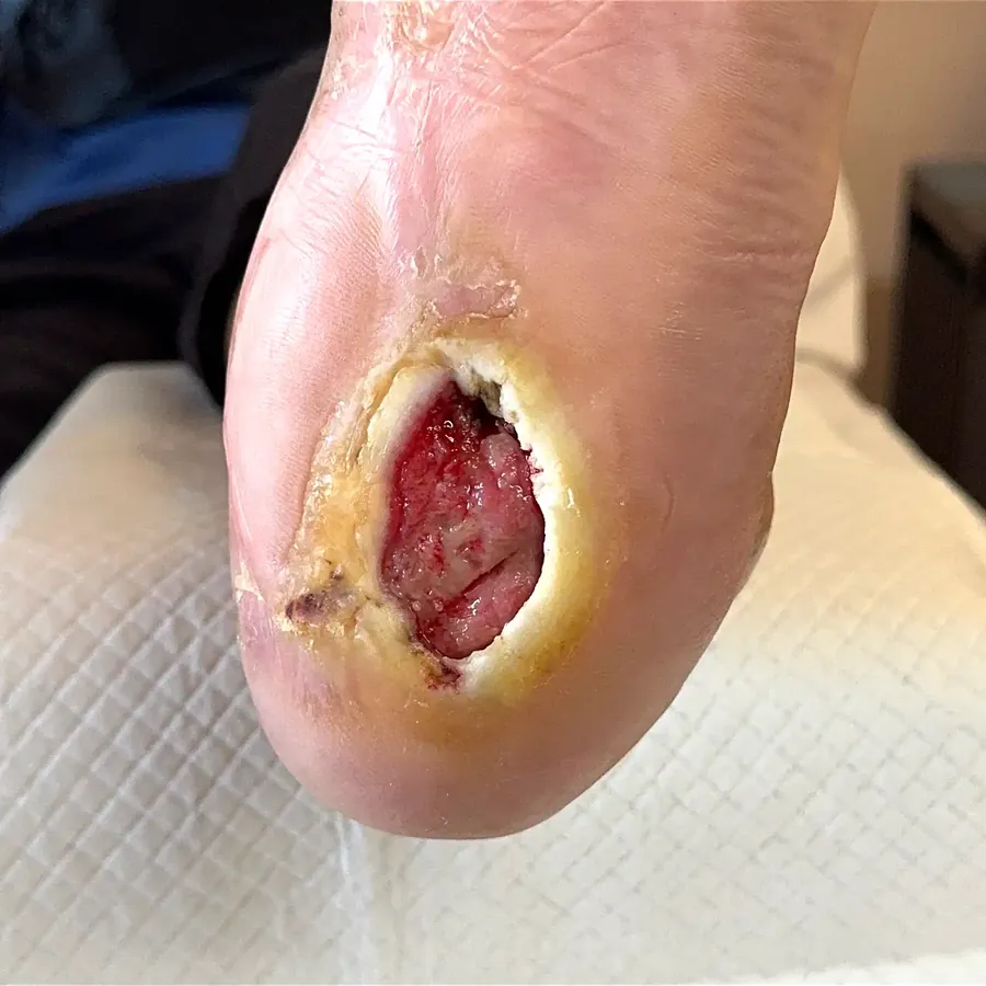 Clinical photograph of a diabetic heel wound at visit 5, HKL-46