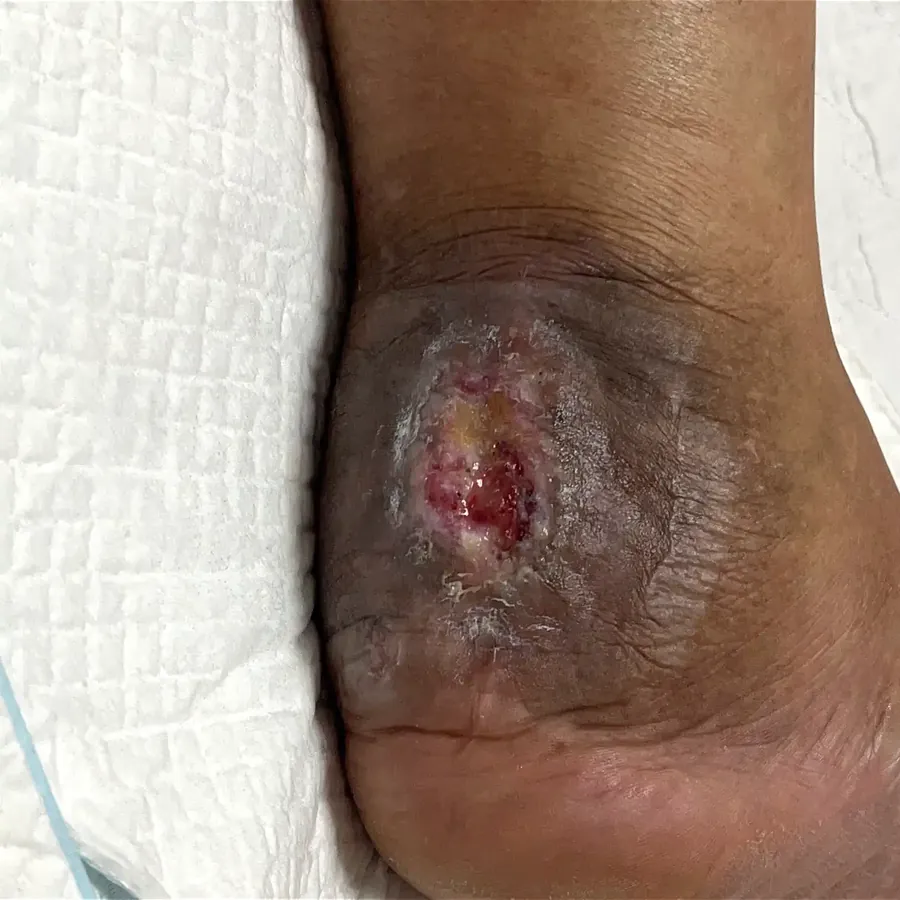 Clinical photograph of a diabetic heel wound at visit 1, HKL-47