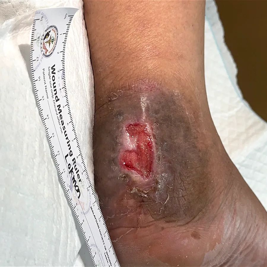 Clinical photograph of a diabetic heel wound at visit 2, HKL-47