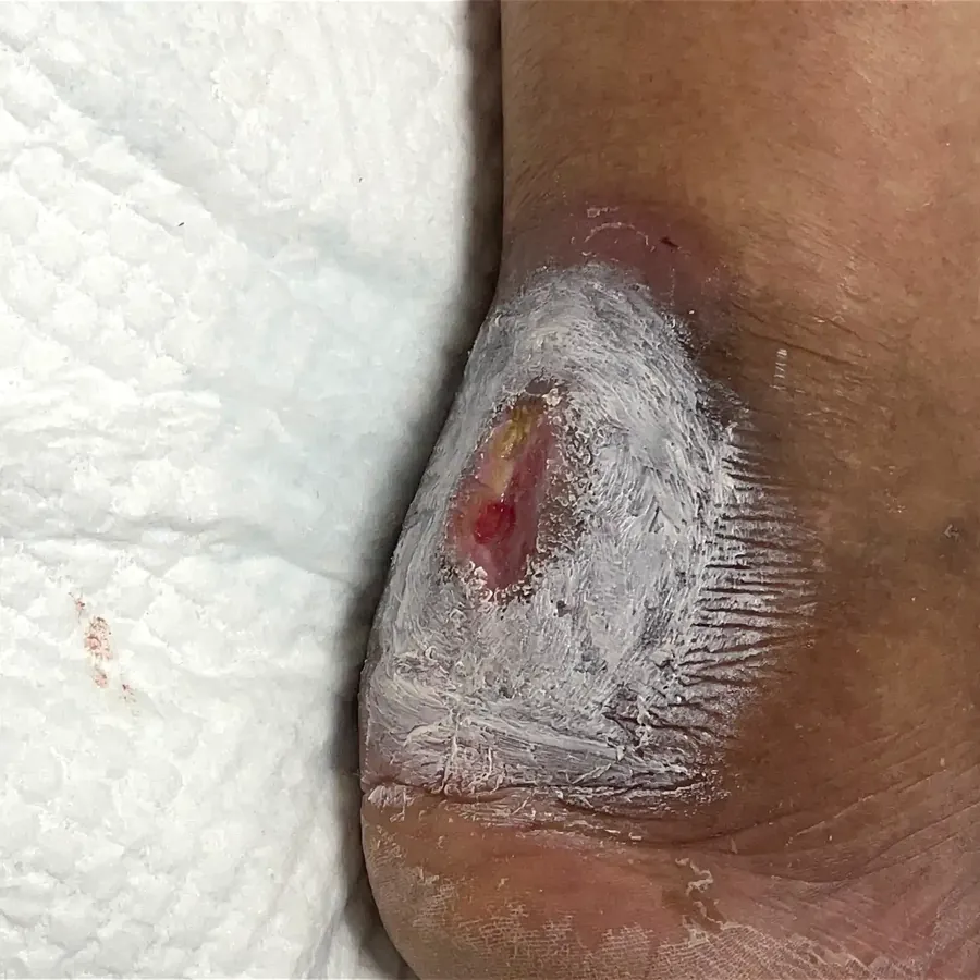 Clinical photograph of a diabetic heel wound at visit 3, HKL-47