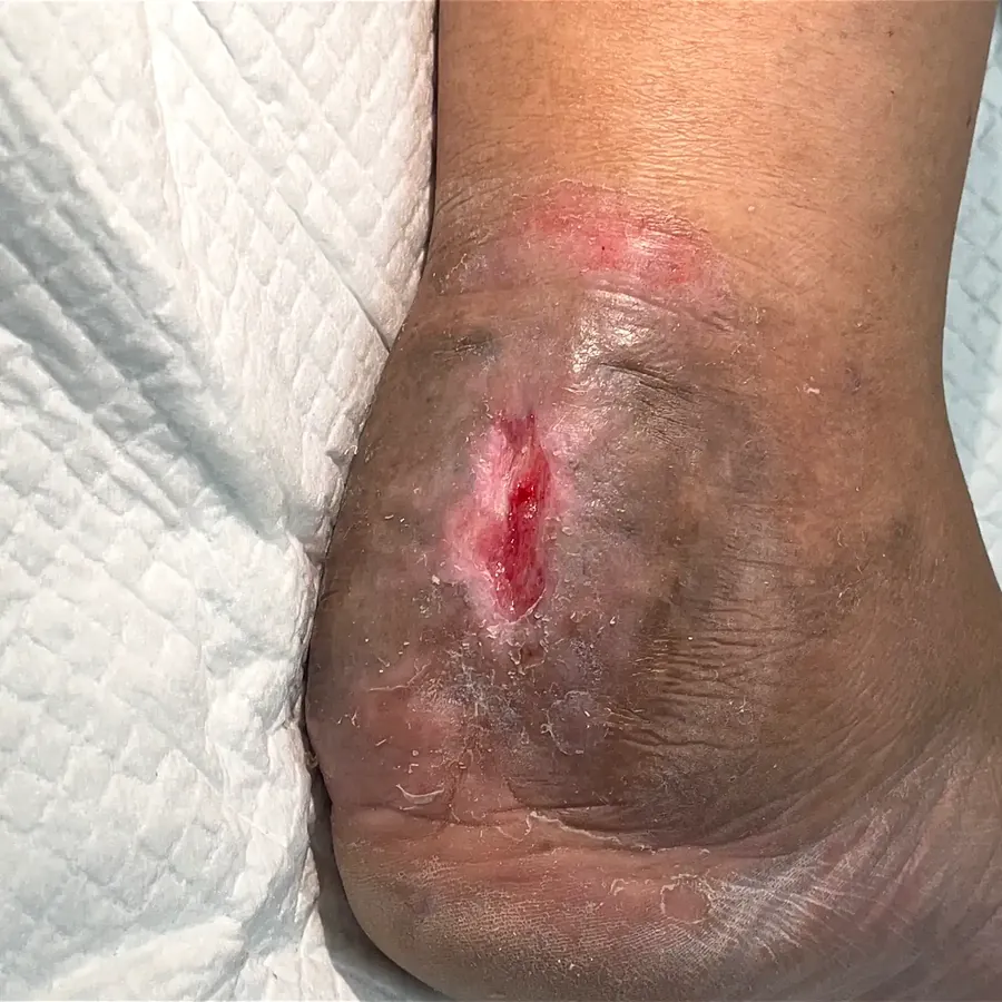 Clinical photograph of a diabetic heel wound at visit 4, HKL-47