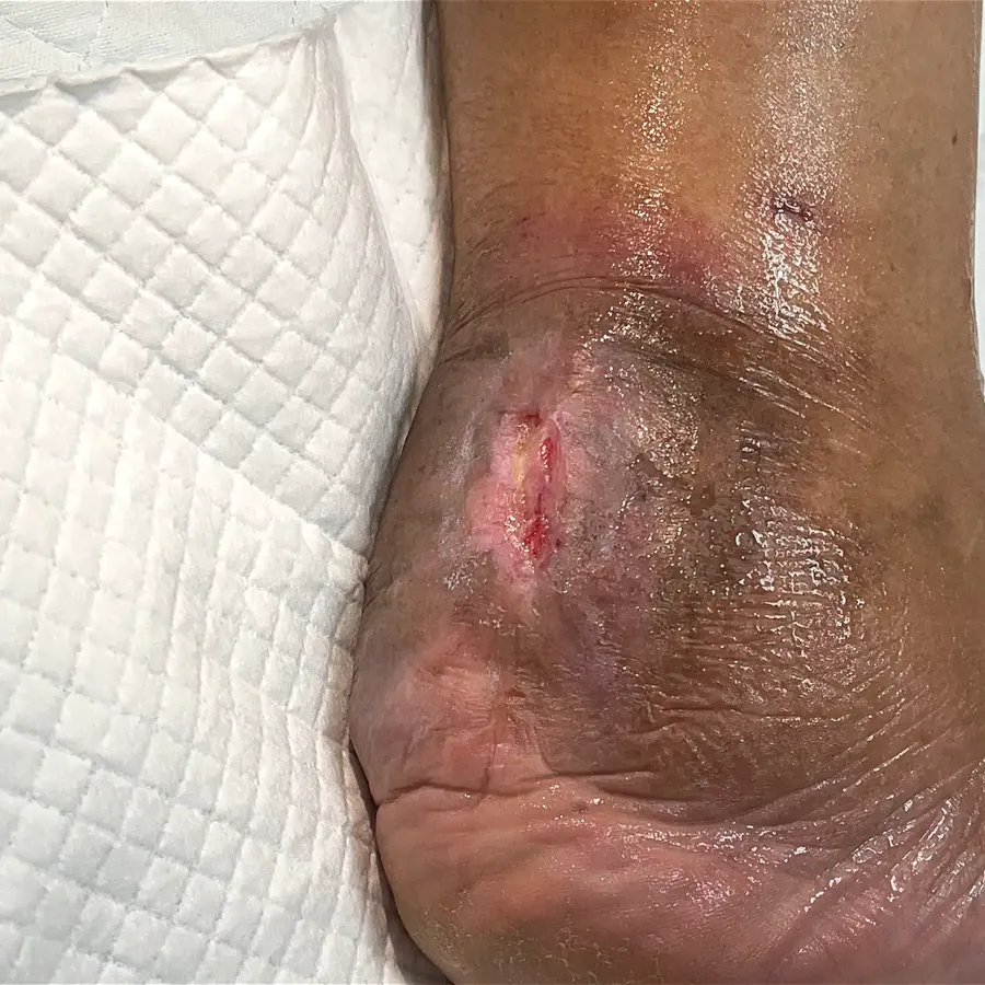 Clinical photograph of a diabetic heel wound at visit 5, HKL-47