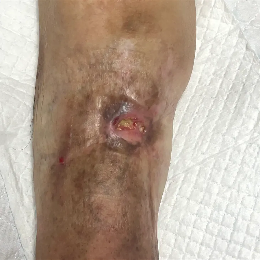 Clinical photograph of a diabetic knee wound at visit 1, HKL-48