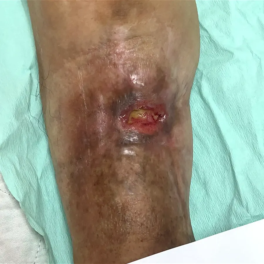 Clinical photograph of a diabetic knee wound at visit 2, HKL-48