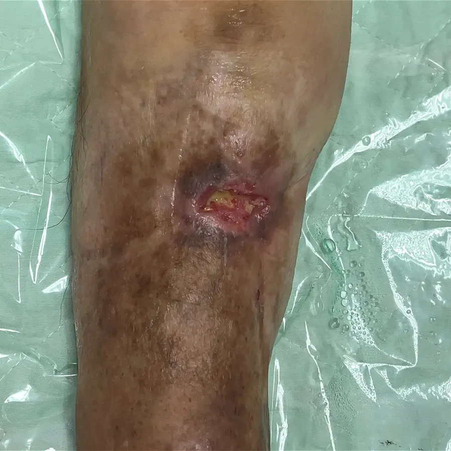 Clinical photograph of a diabetic knee wound at visit 3, HKL-48