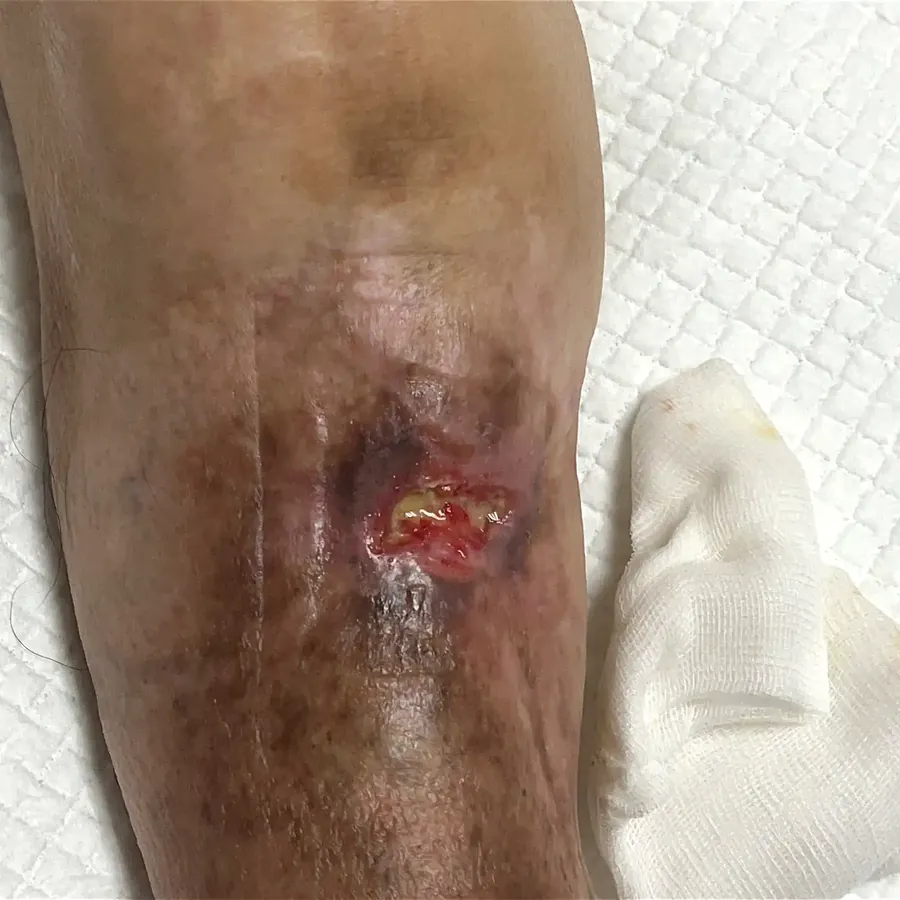Clinical photograph of a diabetic knee wound at visit 4, HKL-48