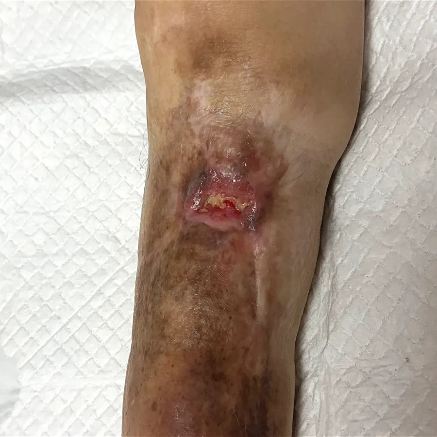 Clinical photograph of a diabetic knee wound at visit 5, HKL-48