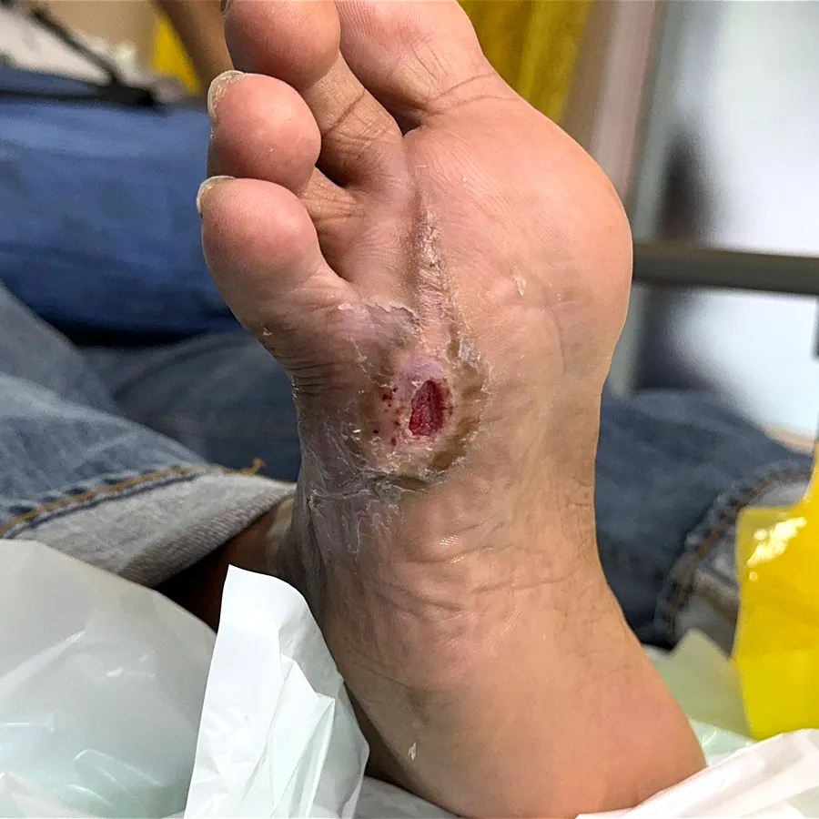 Clinical photograph of a diabetic plantar wound at visit 1, HKL-50