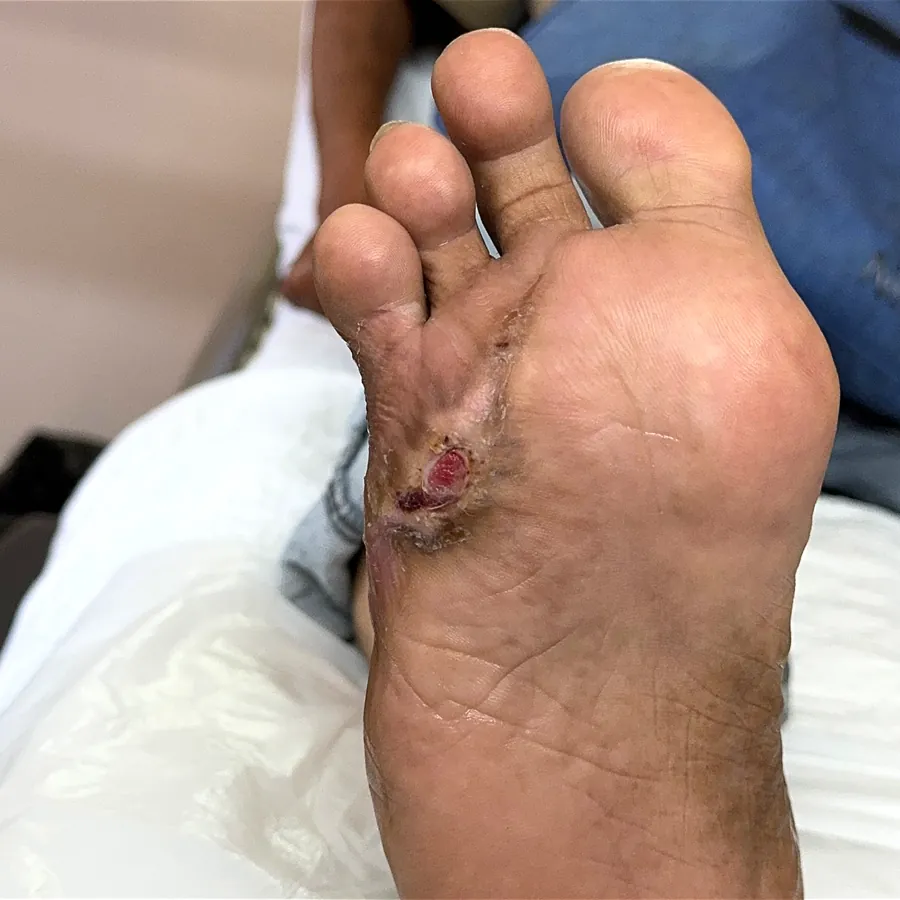 Clinical photograph of a diabetic plantar wound at visit 2, HKL-50