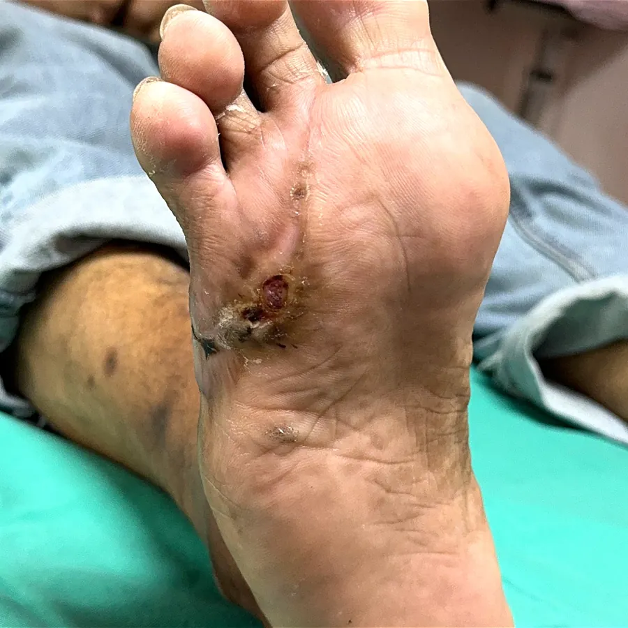 Clinical photograph of a diabetic plantar wound at visit 3, HKL-50
