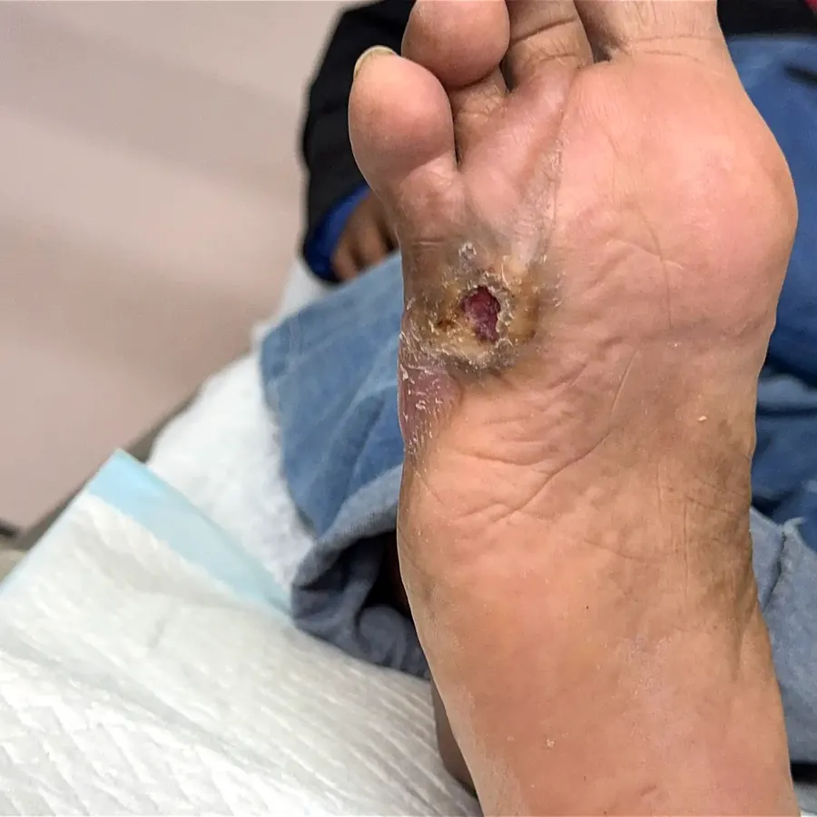 Clinical photograph of a diabetic plantar wound at visit 4, HKL-50