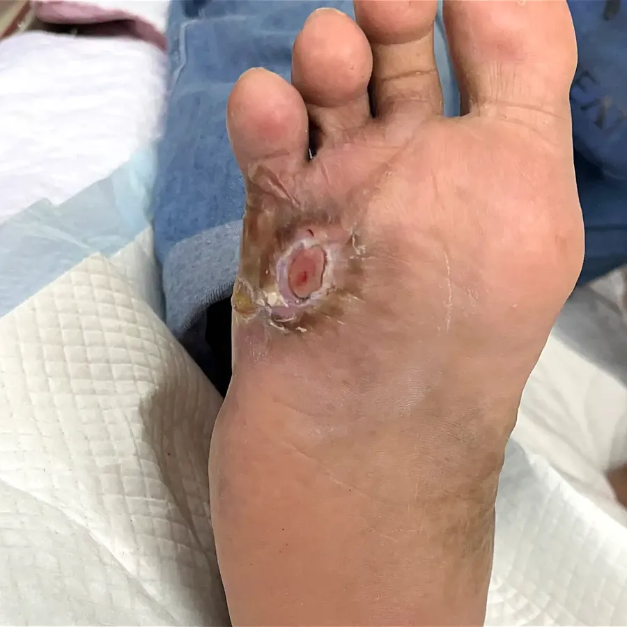 Clinical photograph of a diabetic plantar wound at visit 5, HKL-50