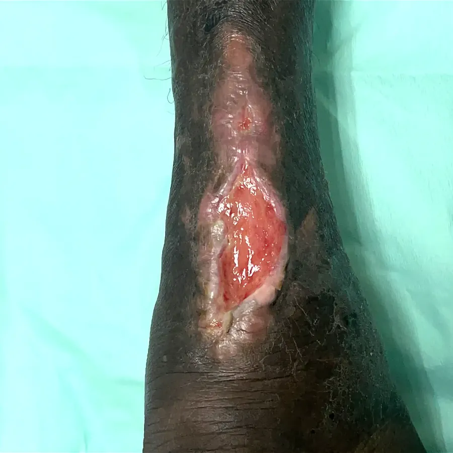 Clinical photograph of a diabetic heel wound at visit 1, HKL-51