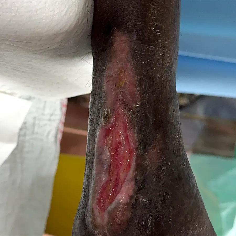 Clinical photograph of a diabetic heel wound at visit 2, HKL-51