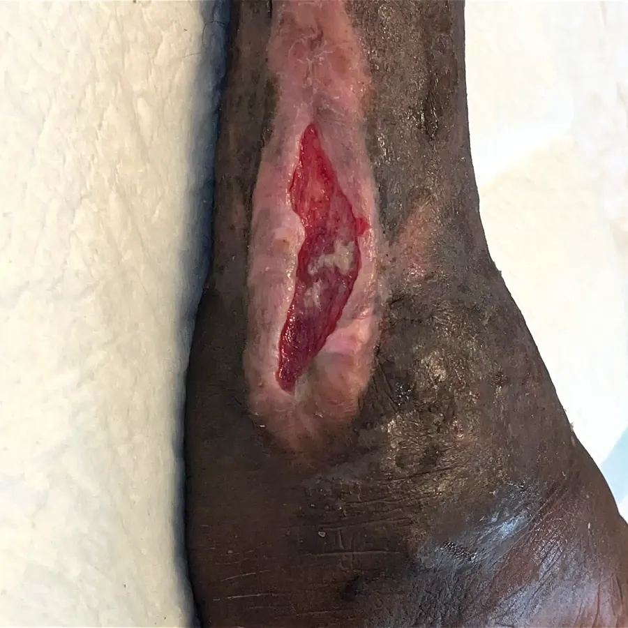 Clinical photograph of a diabetic heel wound at visit 3, HKL-51