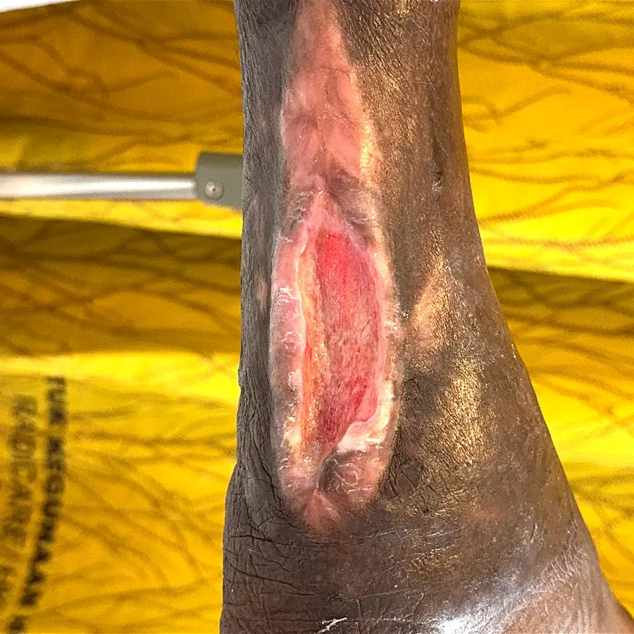 Clinical photograph of a diabetic heel wound at visit 4, HKL-51