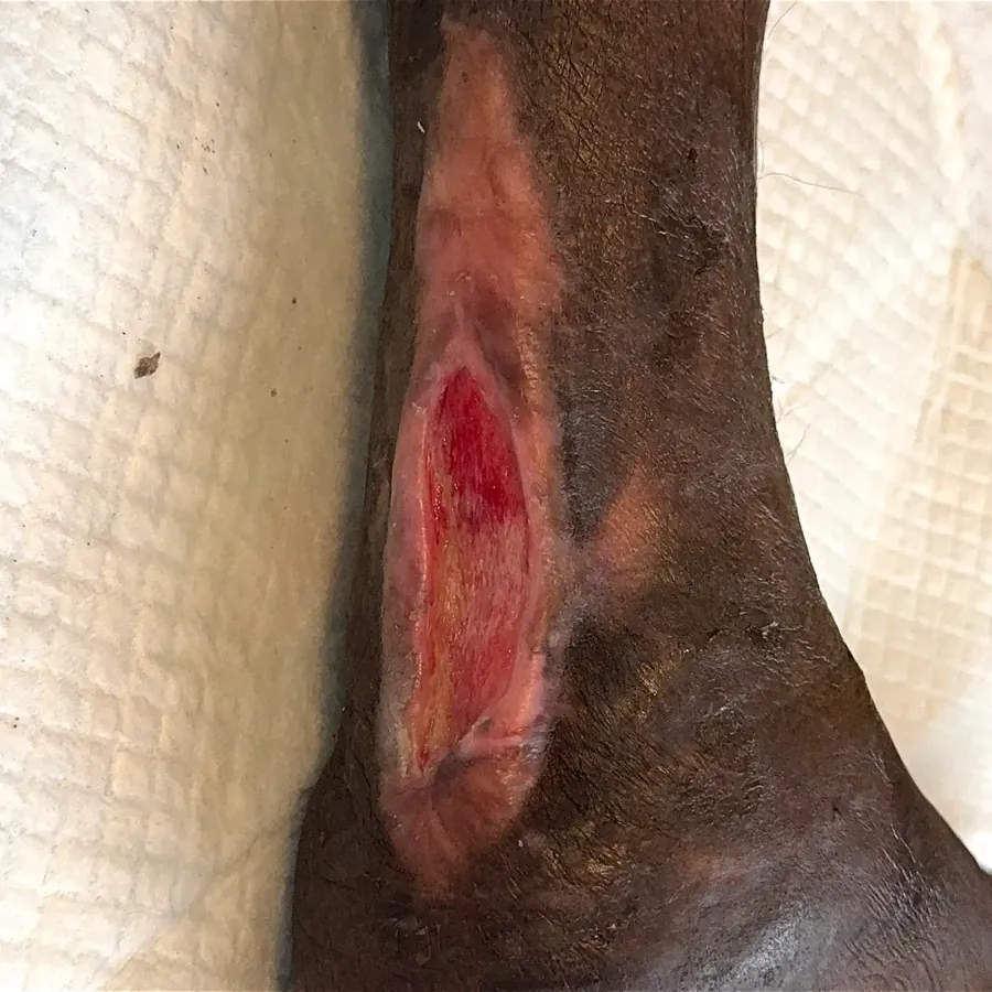 Clinical photograph of a diabetic heel wound at visit 5, HKL-51