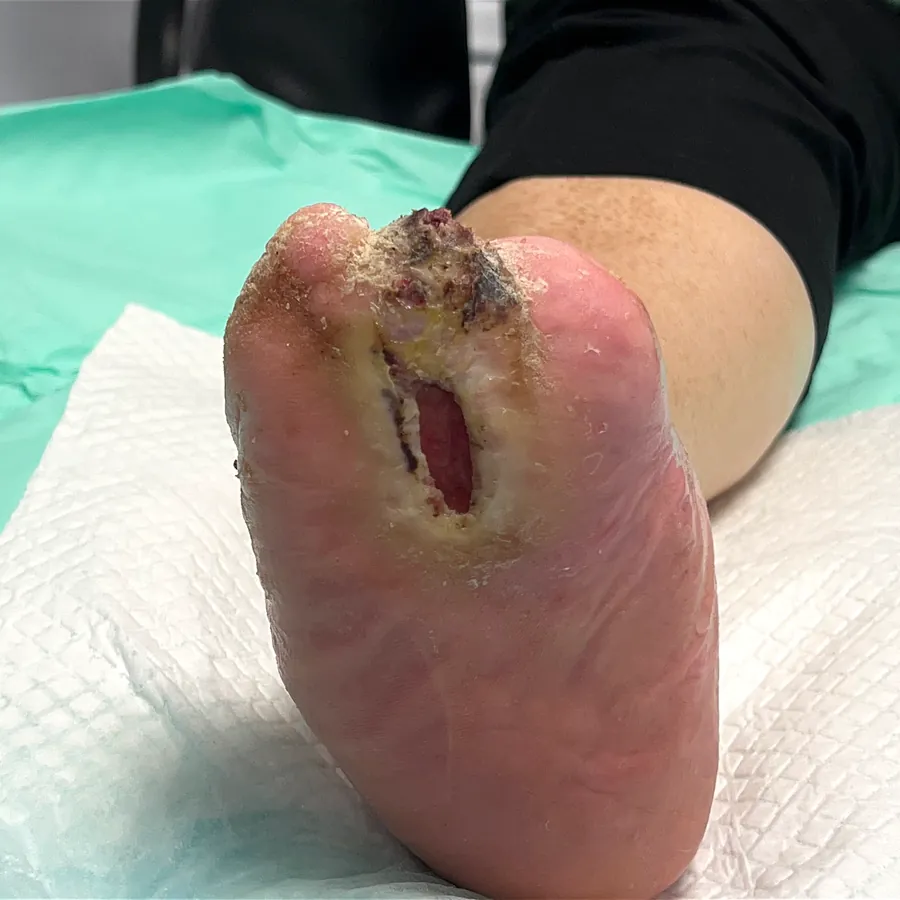 Clinical photograph of a diabetic plantar wound at visit 1, HKL-52
