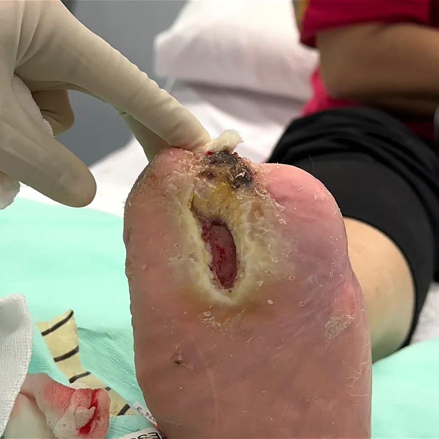 Clinical photograph of a diabetic plantar wound at visit 2, HKL-52