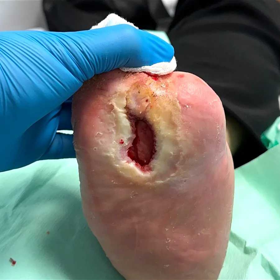 Clinical photograph of a diabetic plantar wound at visit 3, HKL-52
