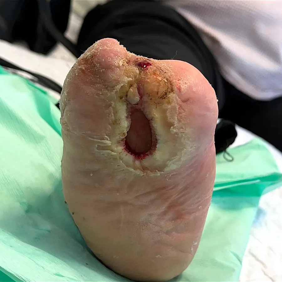 Clinical photograph of a diabetic plantar wound at visit 4, HKL-52