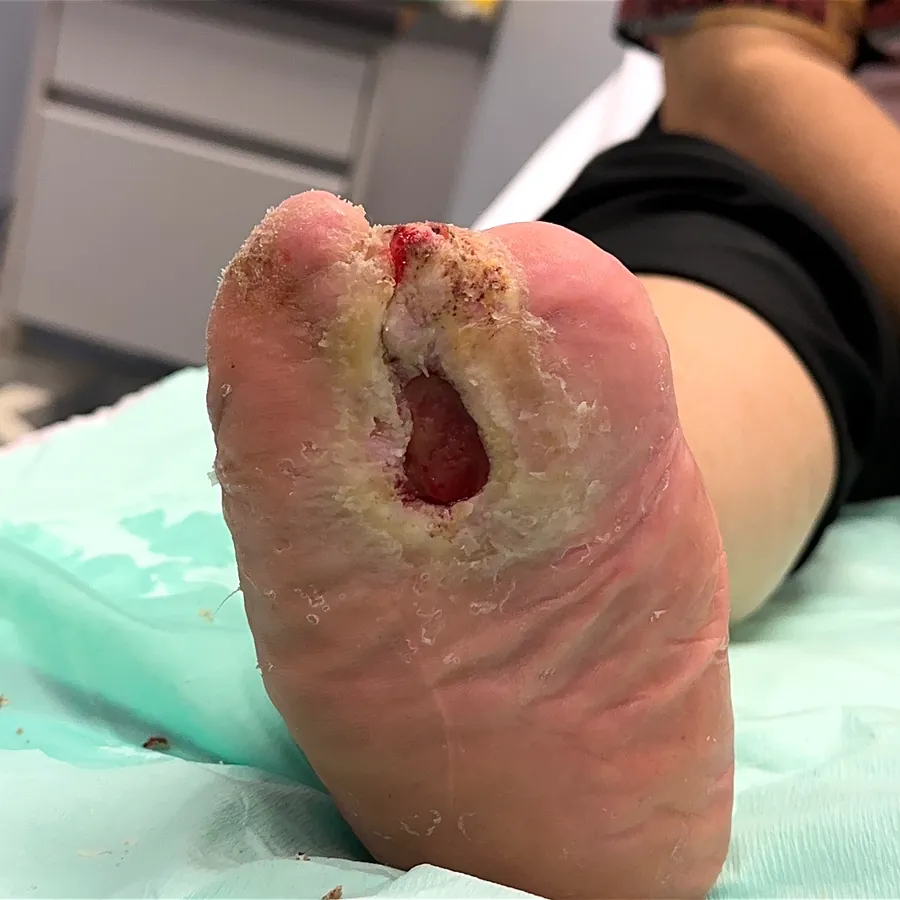 Clinical photograph of a diabetic plantar wound at visit 5, HKL-52